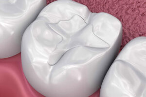 Best Tooth Fillings in Gurgaon: Types, Pros Cons and Cost
